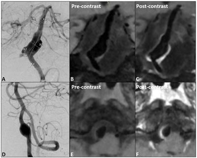 Wall enhancement predictive of abnormal hemodynamics and ischemia in vertebrobasilar non-saccular aneurysms: a pilot study